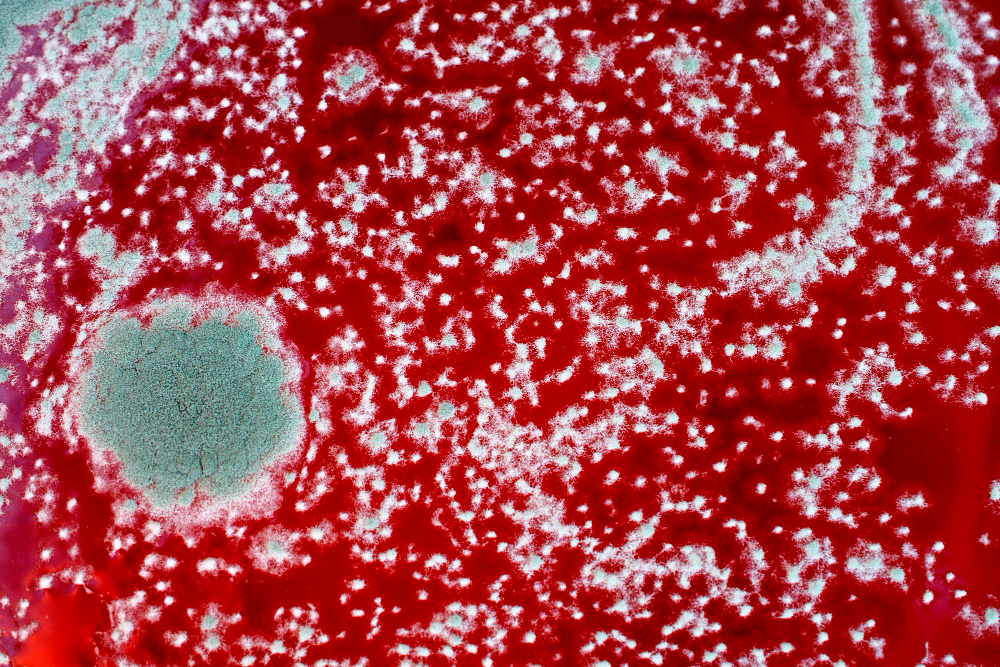 Sfecla roșie și efectele sale în oprirea celulelor canceroase